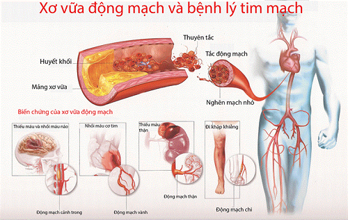 CÁC YẾU TỐ GÓP PHẦN PHÁT TRIỂN MẢNG XƠ VỮA ĐỘNG MẠCH